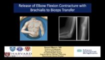 Release of elbow flexion contracture with brachialis to biceps transfer