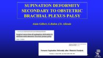 Results and indications of surgery for supination contracture