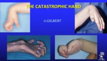 Is there anything to do for a “catastrophic” hand?