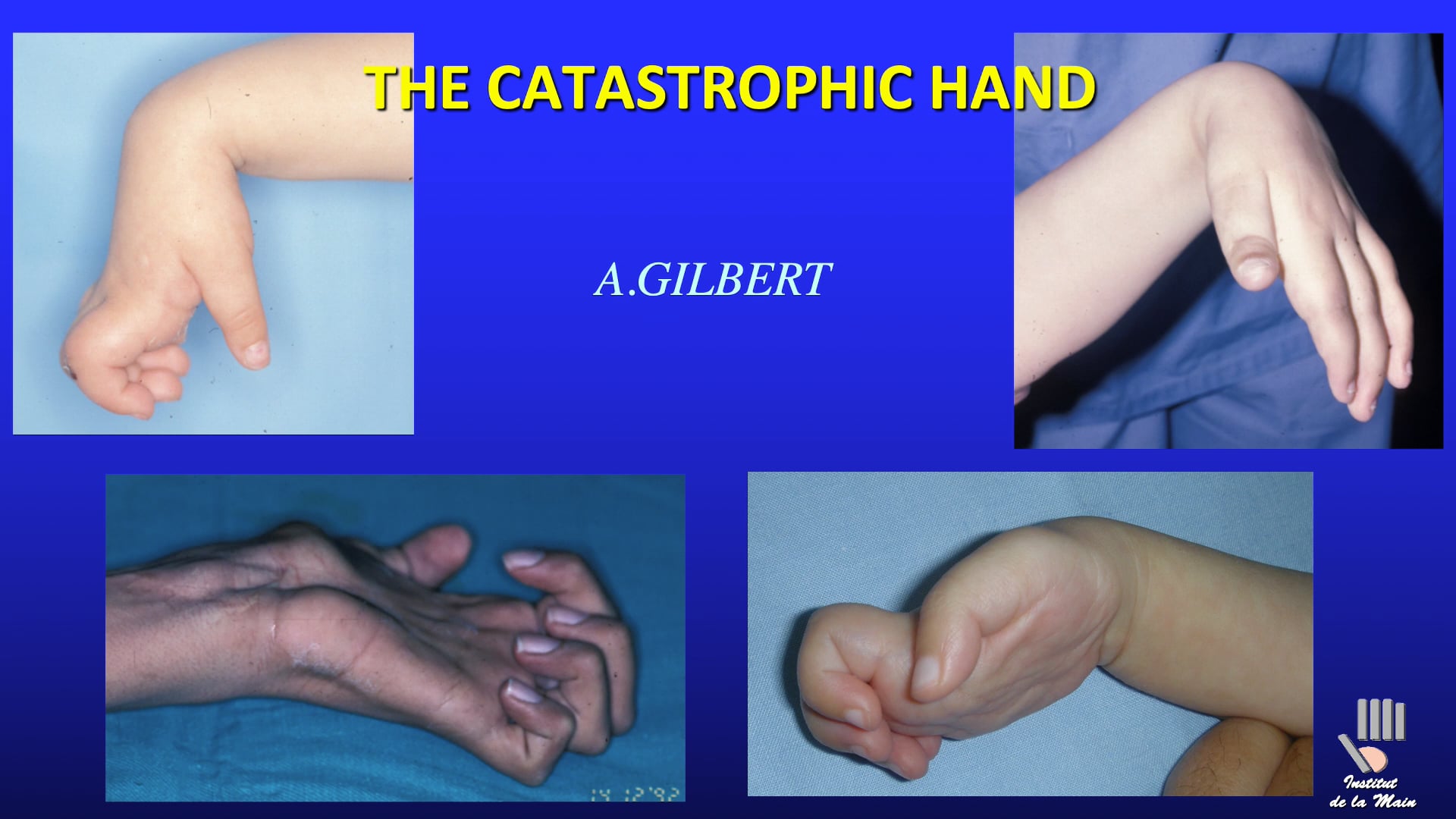 Is there anything to do for a “catastrophic” hand?
